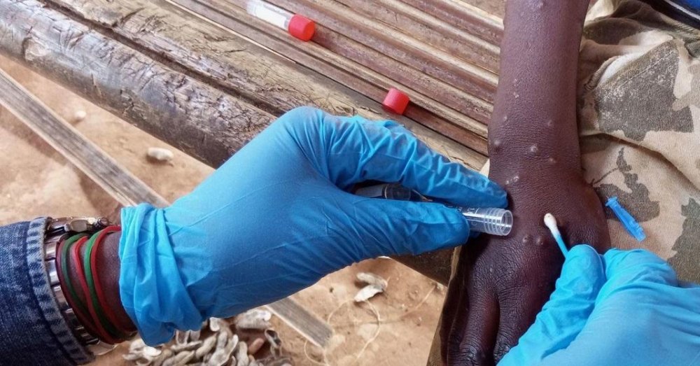 Mpox: Un appel de fonds lancé pour une aide d'urgence aux migrants