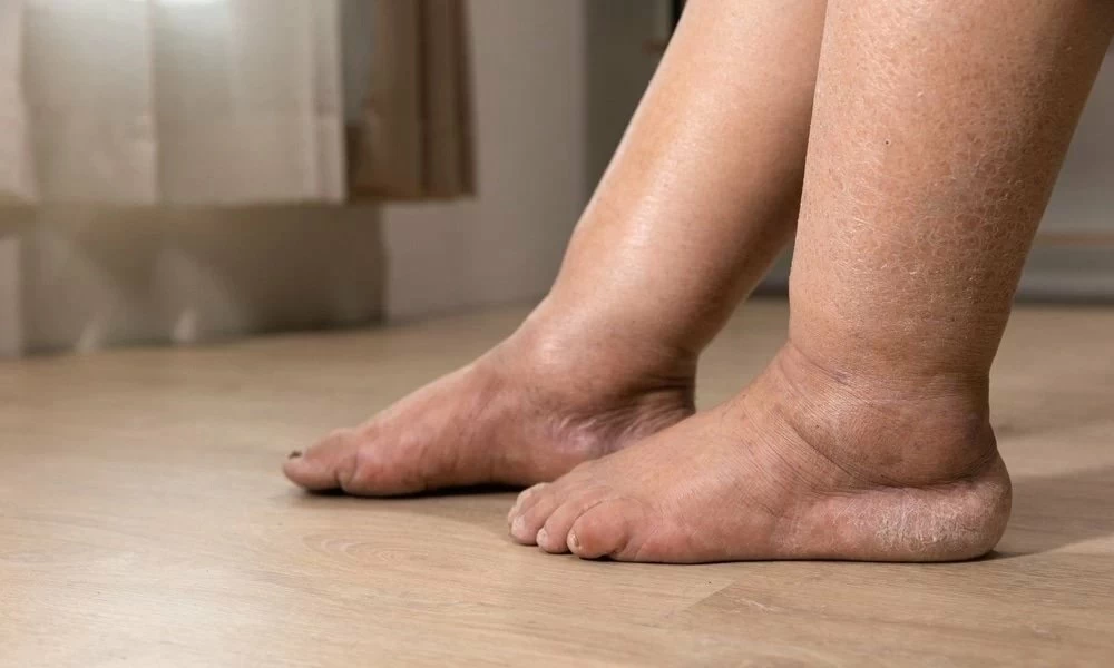 Lipœdème : une association voit le jour pour briser le silence autour d’une maladie méconnue