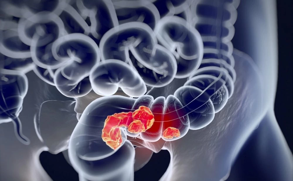 Cancer colorectal : le dépistage doit être régulier à partir de 45 ans (Dʳ Fahd Ghalim)